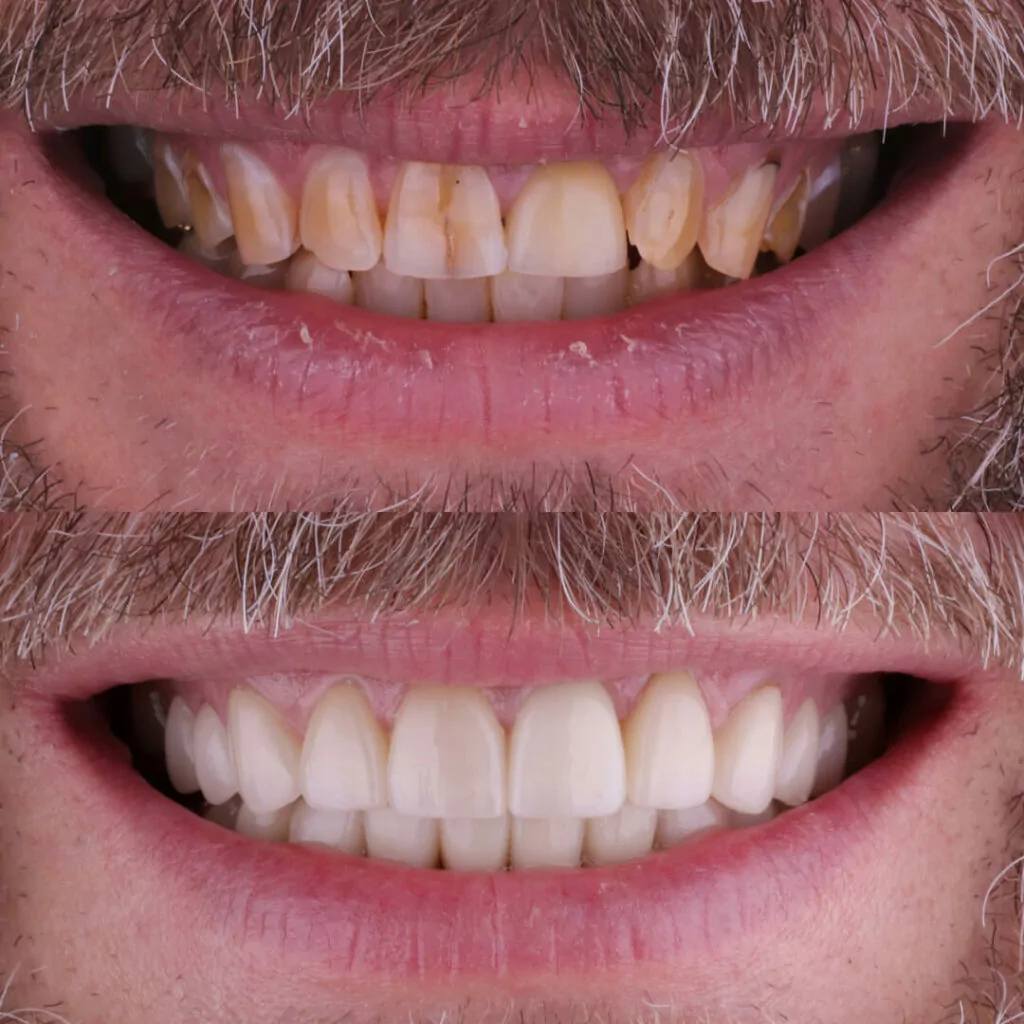 A before-and-after dental image compares discolored, uneven teeth with bright, aligned results after treatment. The visual highlights improved whiteness and symmetry following professional care.