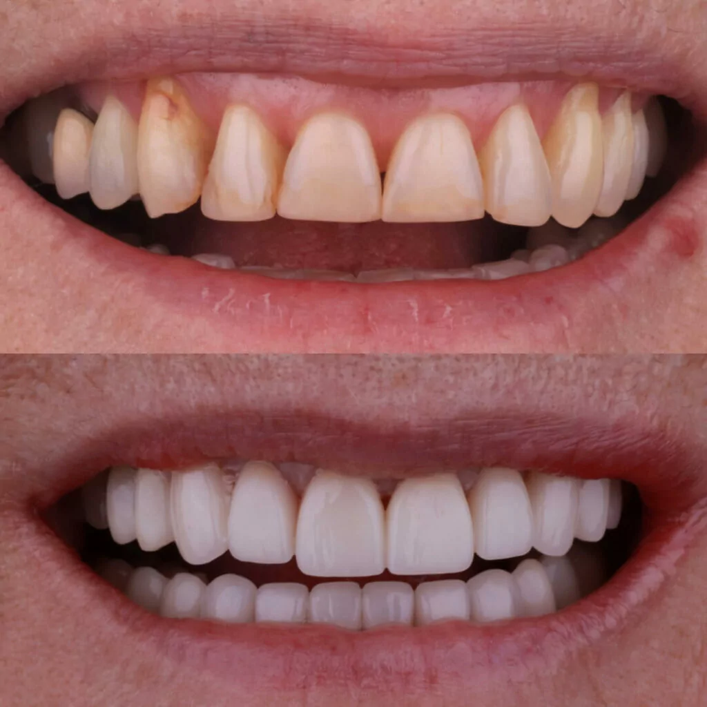 A before-and-after dental image displays yellowed, uneven teeth compared with bright, straight teeth following treatment. The visual emphasizes whitening, alignment, and aesthetic improvement through professional care.