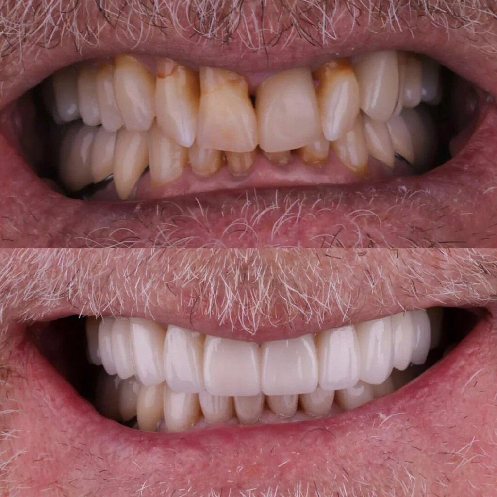 A before-and-after dental image reveals misaligned, discolored teeth contrasted with straight, white teeth after treatment. The transformation showcases improved alignment, brightness, and overall aesthetic through professional dental care.