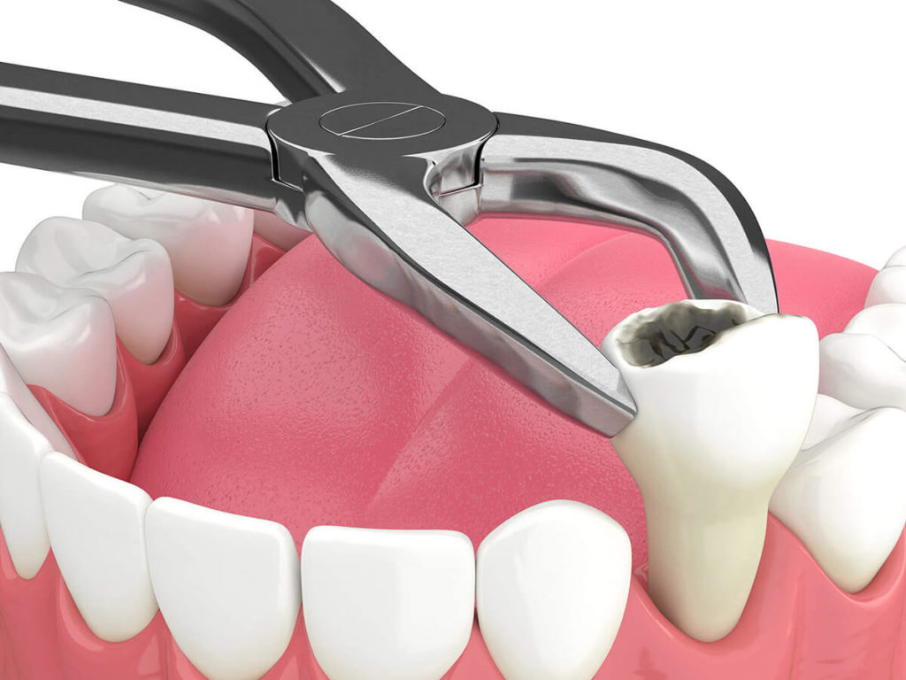 illustration mock up of tooth extraction on the lower row