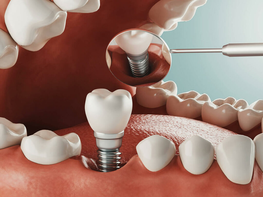 dental implant being placed on bottom tooth