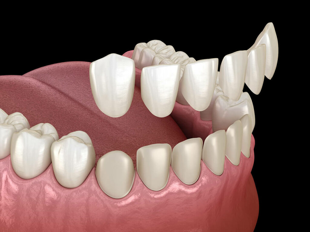 visual mock up of dental veneers being placed on bottom row of teeth
