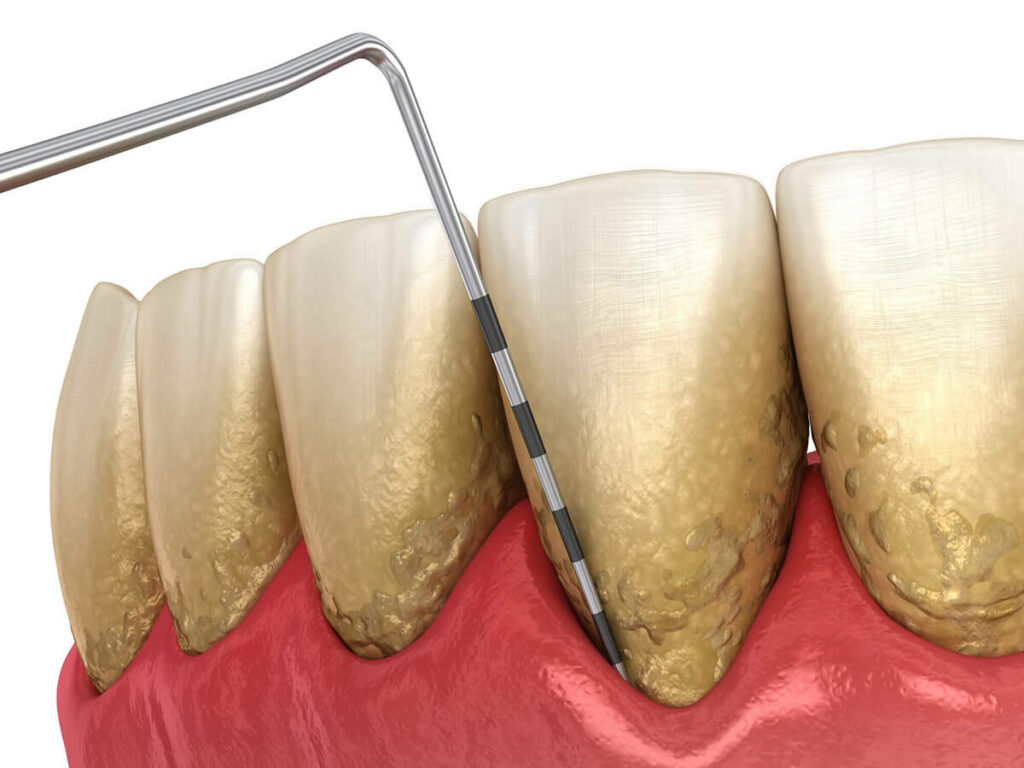 close up visual mock up of dental tooth measuring gum depth