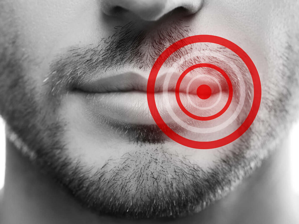 close up of mans lips and chins, red circle representing cold sore location