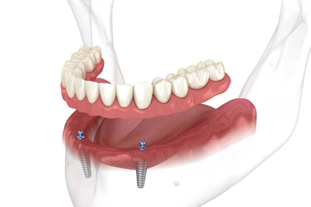 snap on dentures