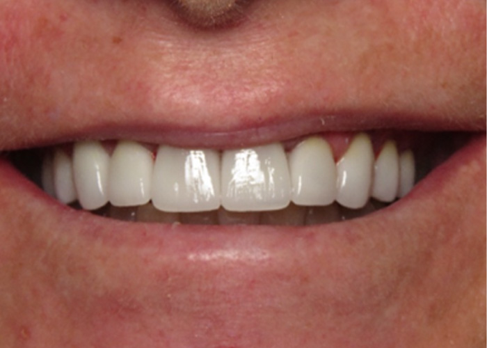 After close up of patient #2's teeth