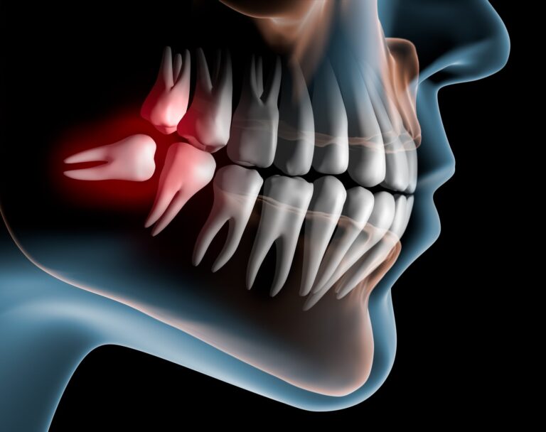 A dental X-ray highlights an impacted wisdom tooth in the lower jaw, marked in red to indicate inflammation or infection. The third molar presses against the adjacent tooth, illustrating a common clinical issue often requiring extraction. The surrounding bone structure and other teeth are clearly defined to support diagnostic evaluation