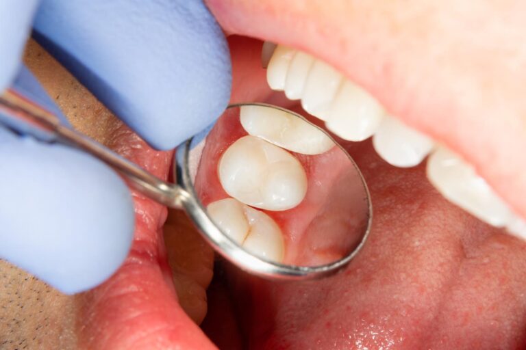 A close-up shows a dental mirror reflecting molars during an oral examination. The gloved hand of a dental professional holds the mirror, highlighting tooth alignment and condition inside a clean, sterile environment,emphasizing the role of preventive care in maintaining oral health.
